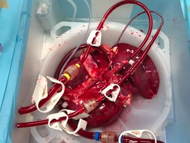 Donor liver connected to red perfusion tubing in a transparent organ basin